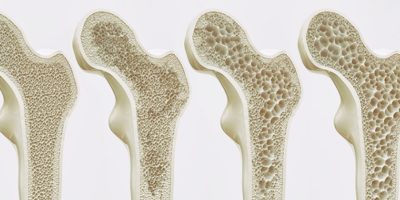 Osteoporosis Y Fisioterapia